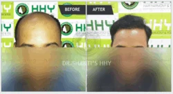 What are the causes and treatments for male pattern baldness ?