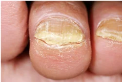 Is there A Hope to Cure Toenail Fungus?