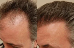 San Francisco Bay Area Leader in Robotic Hair Transplant, Silicon Valley Hair Institute Announces New Post on Advantages of Modern Hair Restoration