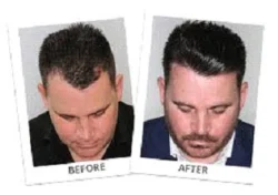 The Ultimate Guide to Hair Transplant in Mexico City