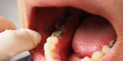 Children Dentistry: Why Your Child May Need Sealants or Fillings