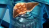 What Are Your Treatment Options for Liver Cancer?