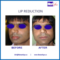 Lip reduction surgery – procedure and cost