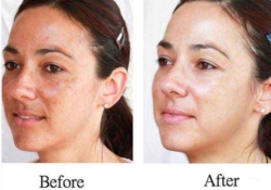 First Impressions Last With Meladerm Skin Lightening Cream