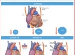 78% Stroke Reduction with Newer No-Touch Beating Heart Bypass Surgery, According to Landmark Study
