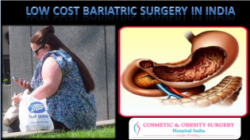 Bariatric Surgery Can Help Women Suffering From Obesity to Lose Weight