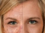New Selfie-App Helps to Prevent Skin Cancer