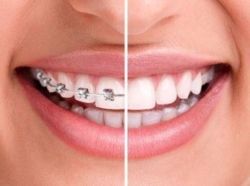 Exeter Orthodontics Brings Braces for Teens and Adults to Reading for $3,995