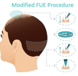Why should one opt for a Hair transplant in Mumbai?