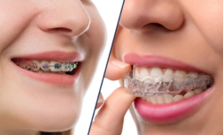 Braces to Invisalign: Making the Switch