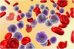 What Is Leukemia And How It’s Diagnosed?