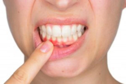 3 Ways To Fight Off The Early Stages Of Gum Disease
