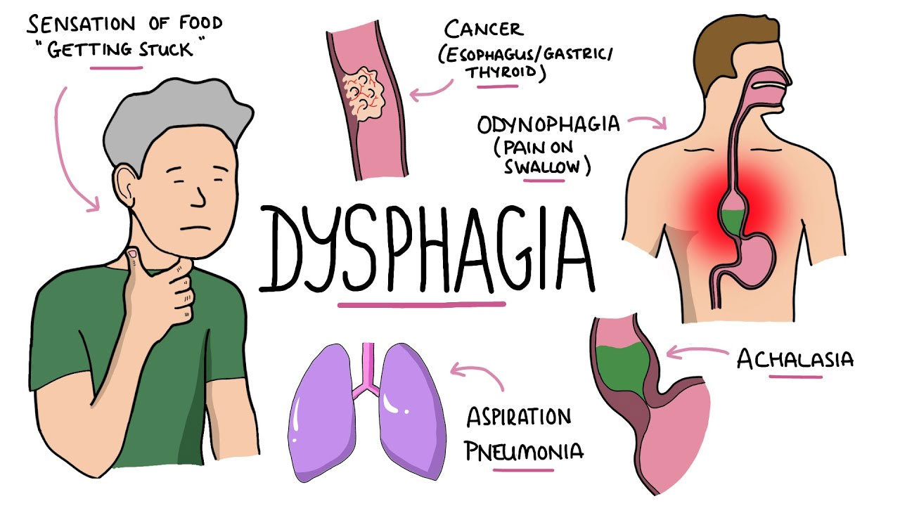 Conditions That Might Result in Dysphagia: Understanding